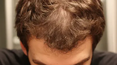 Hair Loss Solutions: A Realistic Look at Options for 2027