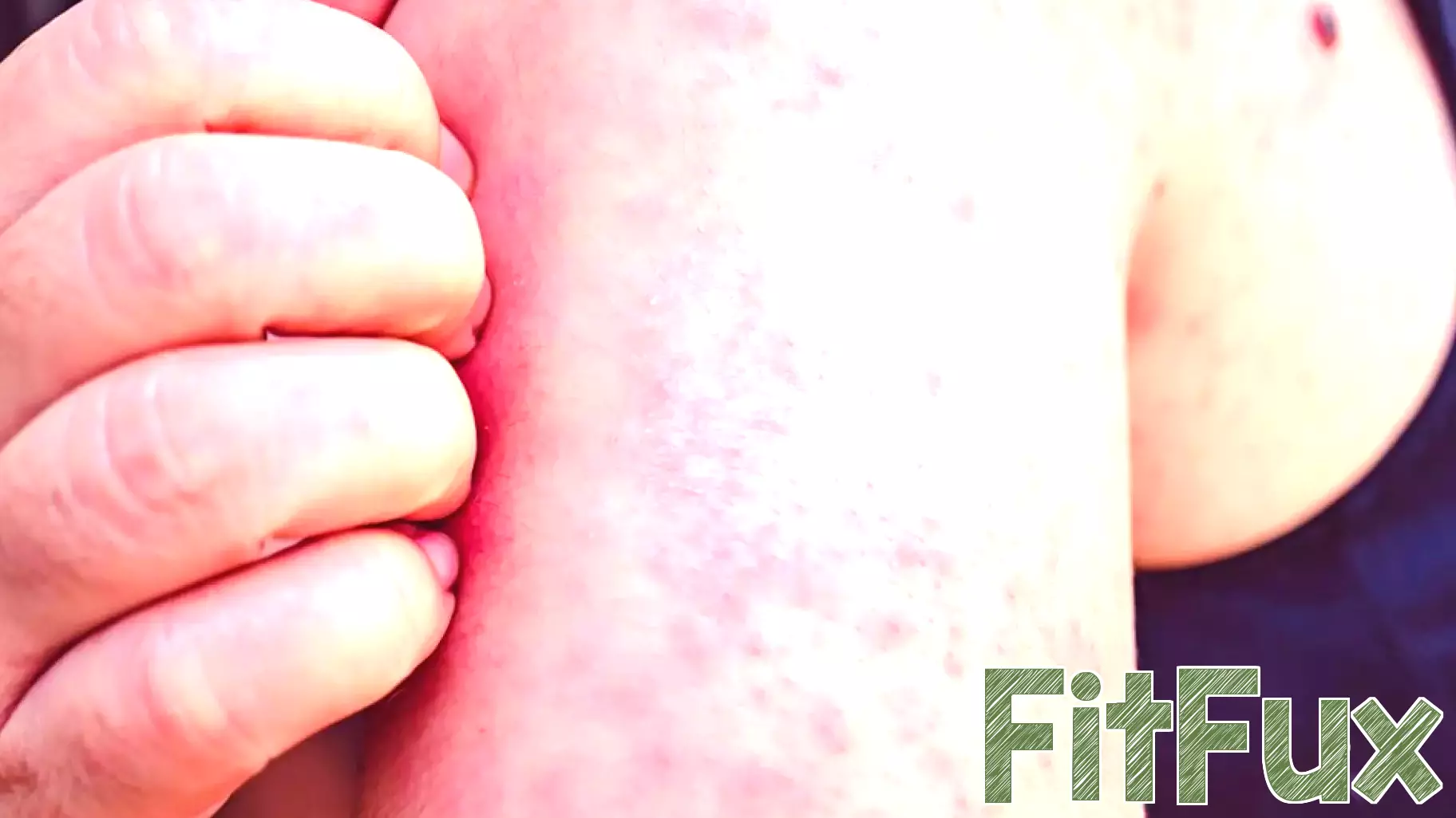 Health Officials Alert Public About Possible Measles Exposure
