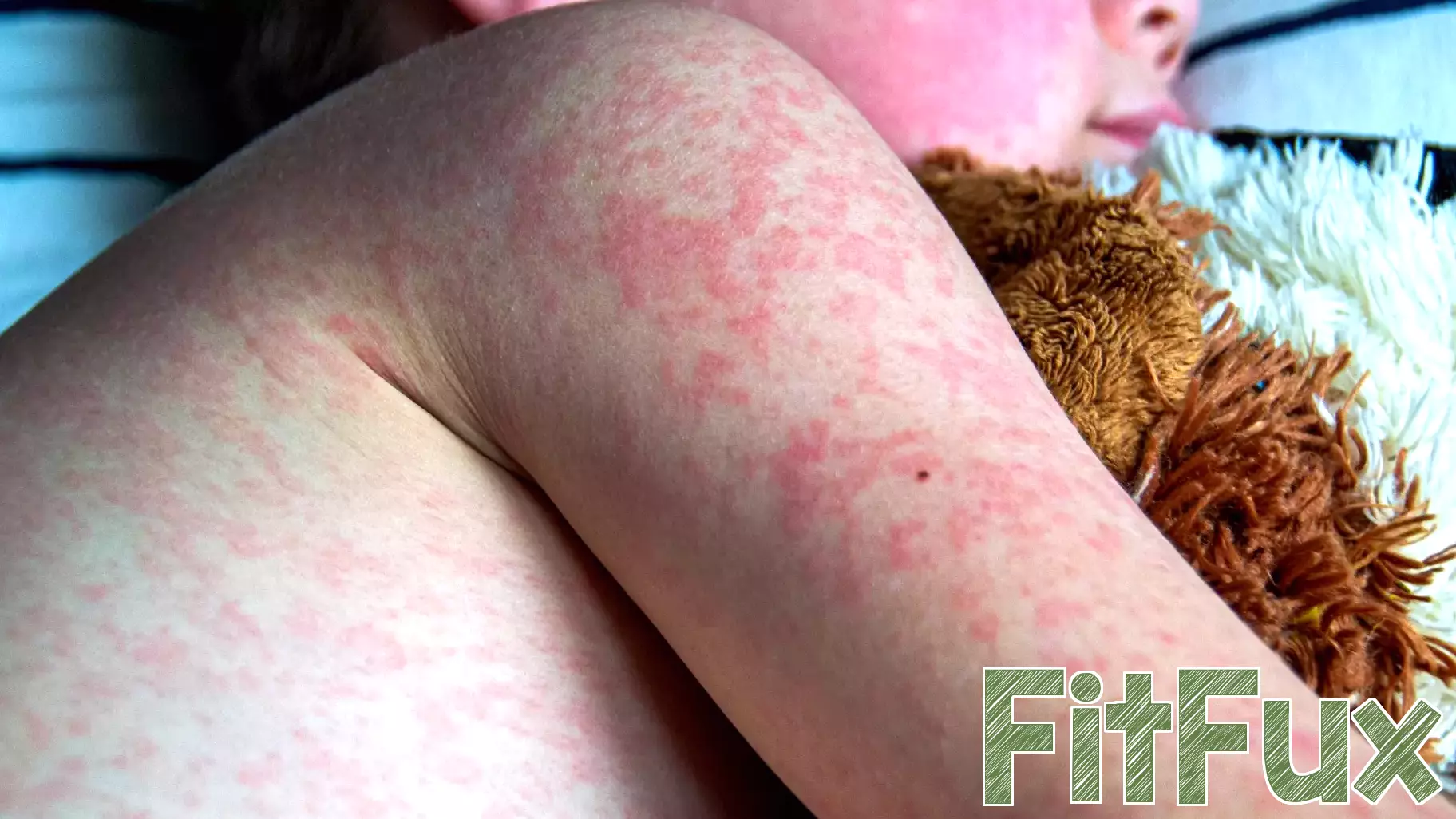 Surge in Measles Cases Reported in Texas