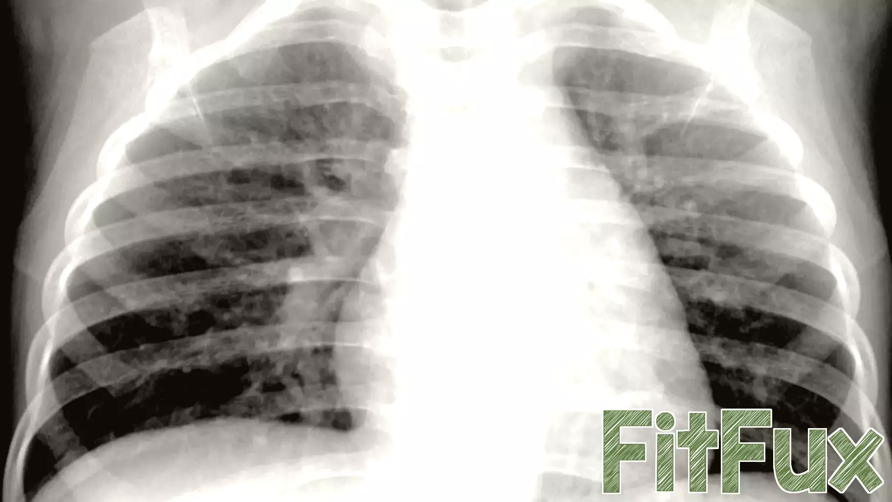 Understanding HMPV: The Virus Currently Spreading in China