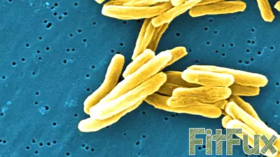 Fulton County health officials warn of Johns Creek school tuberculosis case