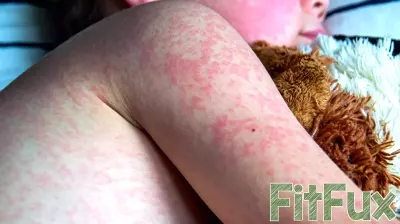Surge in Measles Cases Reported in Texas